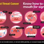How I Knew I Had Throat Cancer My Personal Experience